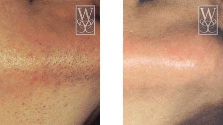 Before and after comparison of facial skin. Hair removal visible, skin tone changes.