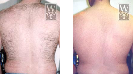 Before and after view of a man's back. The