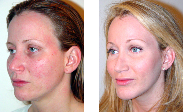 Woman's face before and after treatment for facial redness. Red, inflamed skin on left; smooth skin on right.