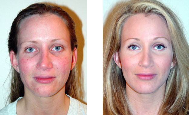 Before-and-after facial comparison: one with red skin, the other with clear skin, both with blonde hair and similar facial expressions.