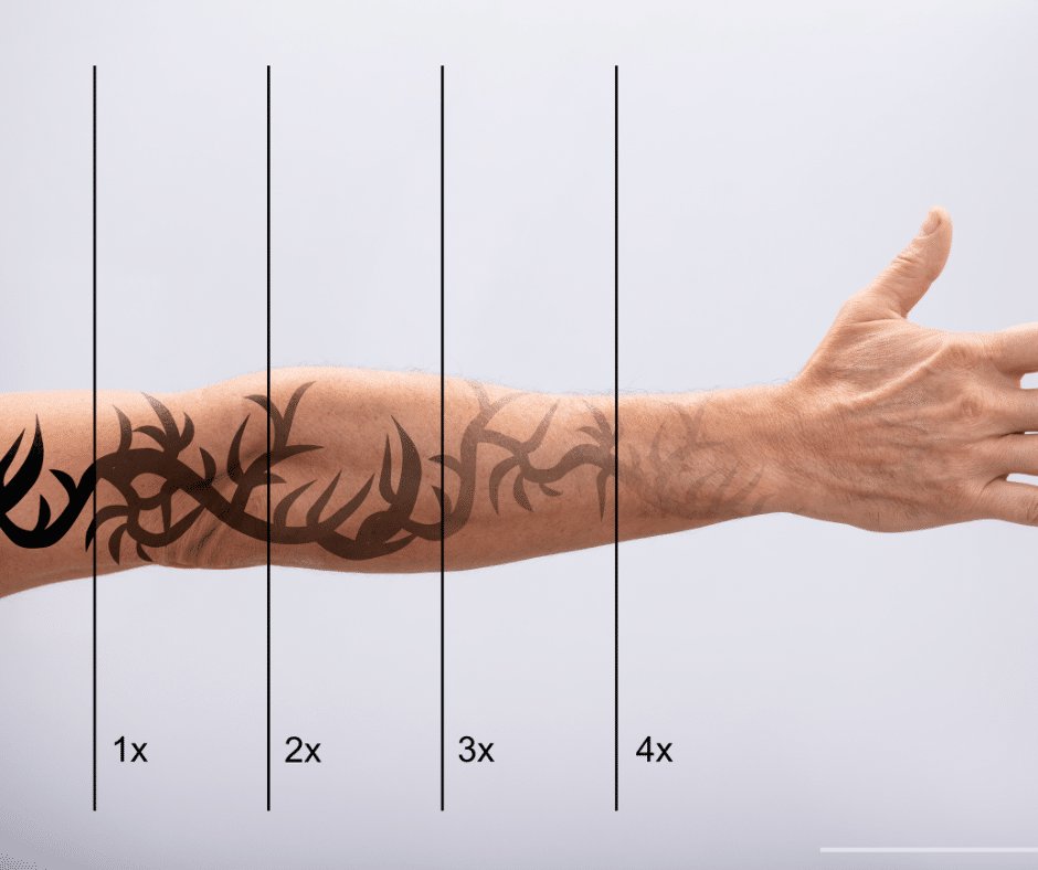 Arm with tribal tattoo, divided into four sections by vertical lines for a potential treatment.