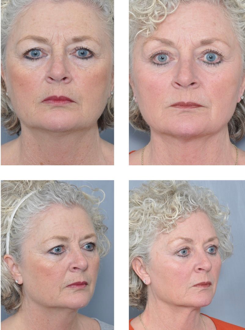 Before and after facial rejuvenation photos. Older woman with wrinkles. Right side shows smoother skin.