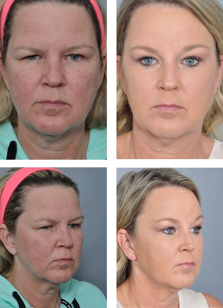 Before and after images of a person's face after a cosmetic procedure, showing a reduction in wrinkles.