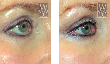 Before and after photos of an eye. The first shows wrinkles, the second is smoother. Both have light eyeliner.