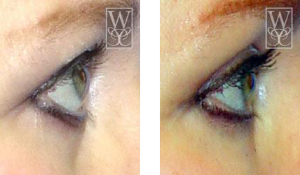 Comparison of an eye before and after cosmetic treatment; green iris, visible eyelashes.