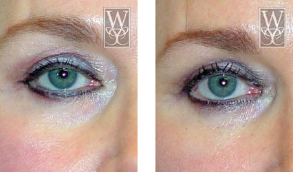 Two side-by-side images of an eye before and after treatment, showing a reduction of under-eye discoloration.