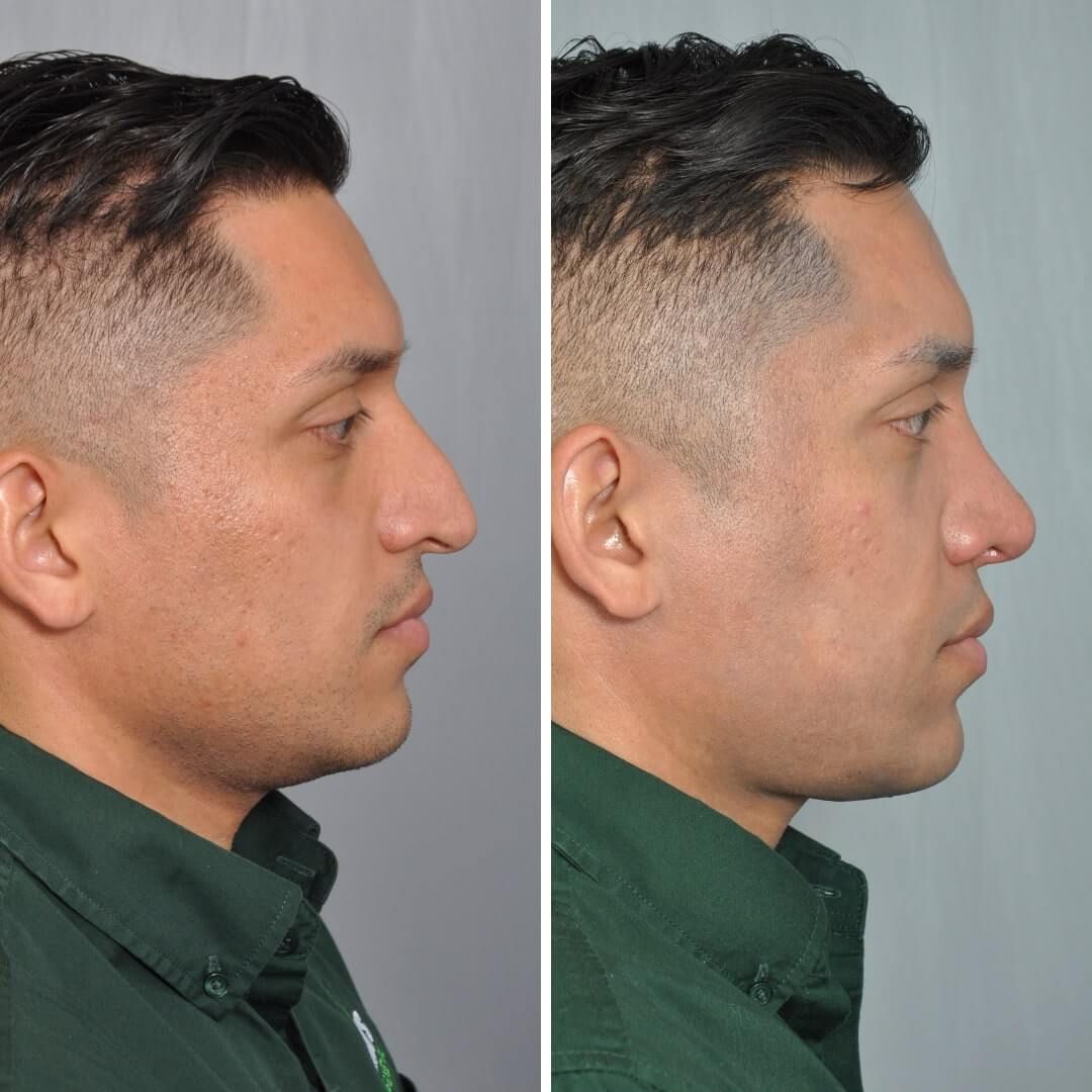 Side-by-side comparison of a man's profile, before and after rhinoplasty. The 