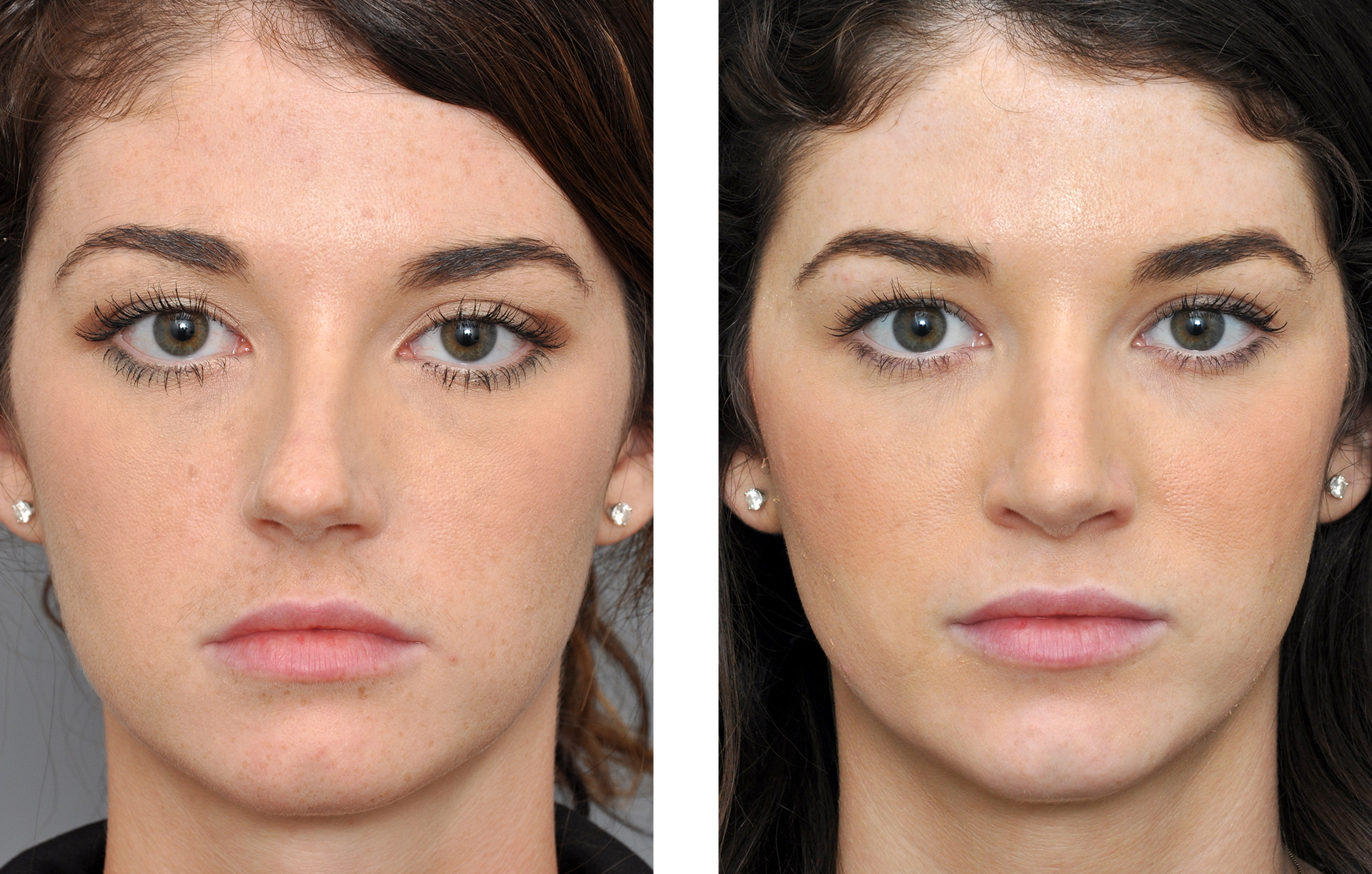 Before and after headshots of a person, appearing to show cosmetic enhancements. The right side shows smoother skin and fuller lips.