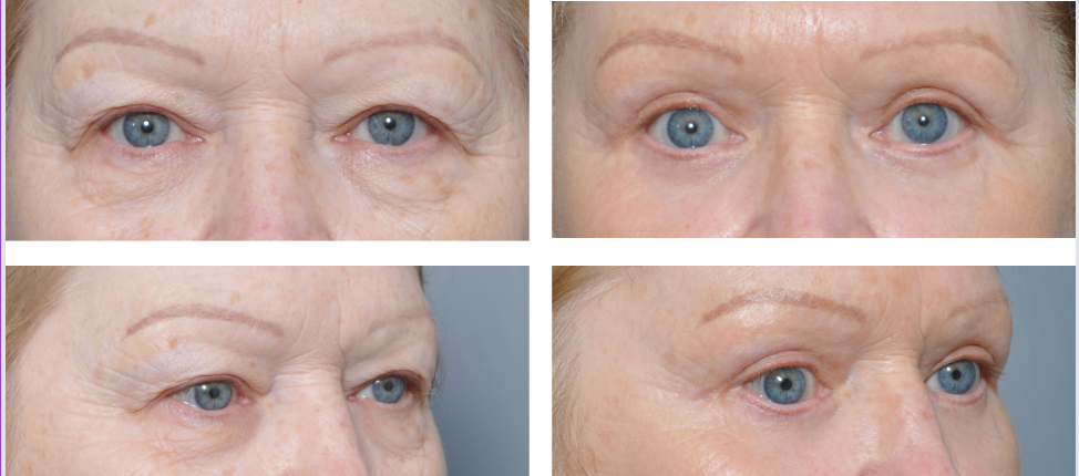 Before and after photos of a person's eyes after a procedure, showing reduced eyelid droop.