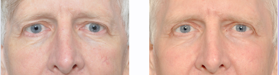 Two close-up facial views, possibly before-and-after, of a person's eyes and nose.