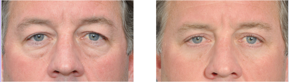 Before and after photos showing cosmetic eyelid surgery results.