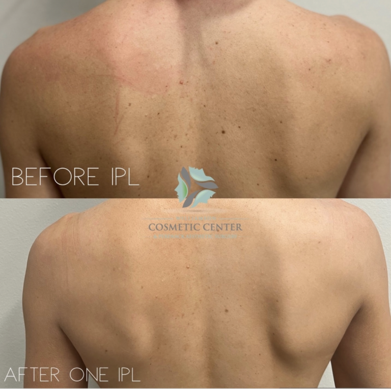 Comparison of a person's back before and after one IPL treatment, showing reduced spots and discoloration.