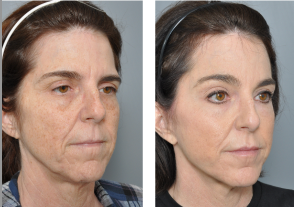 Before and after facial rejuvenation: decreased wrinkles, improved skin tone.