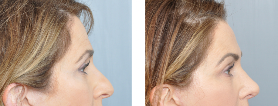 Before and after profile views of a nose, likely rhinoplasty procedure.