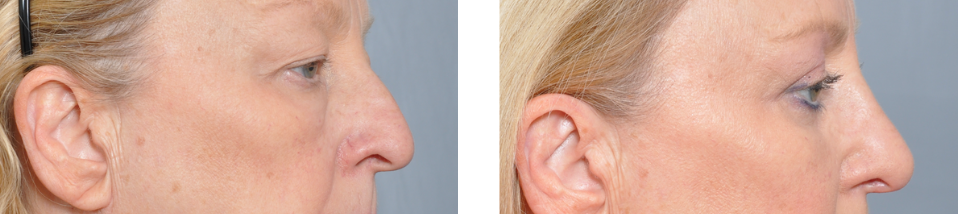 Two side-profile views of a person's face; nose appears to have been reshaped, skin is light in color.