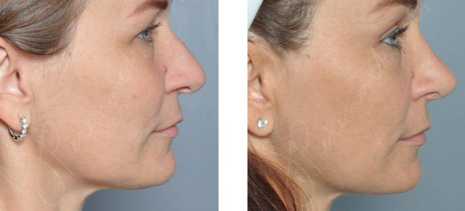Before and after profile views of a woman's face, showing a cosmetic procedure's results.