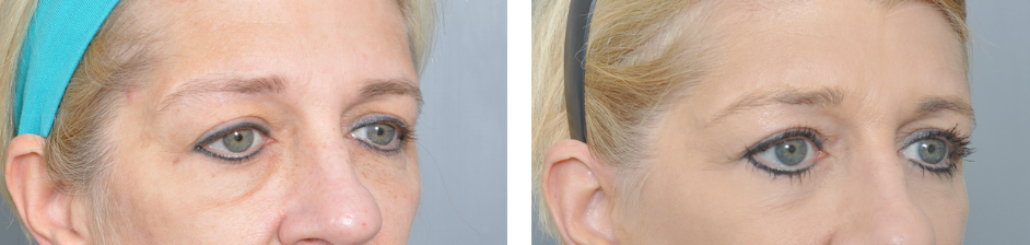 Before and after of a woman's eyes, showing a cosmetic procedure. The 