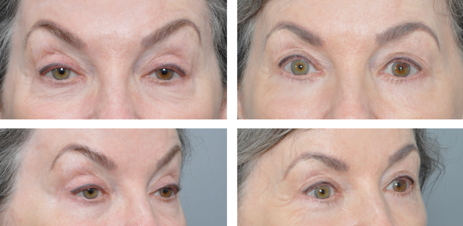 Four close-up views of a person's eyes, displaying before and after aesthetic changes.