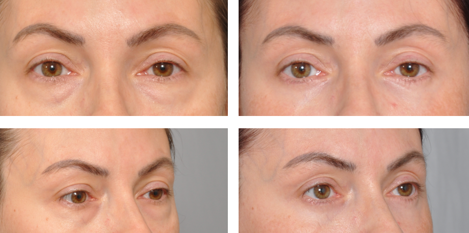 Before-and-after of woman's eyes. Reduced under-eye bags, smoother skin around eyes.