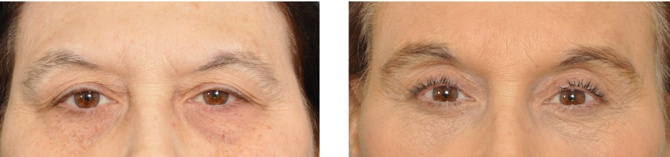 Comparison of eyes before and after blepharoplasty surgery; showing a more open eye appearance.