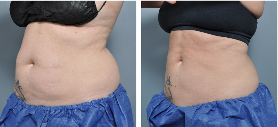 Side-by-side comparison of a person's abdomen, showing before and after results, likely a cosmetic procedure.