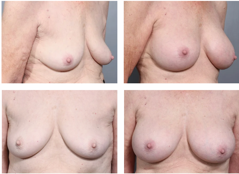 Four views of breasts before and after surgery, showing changes in shape and position.