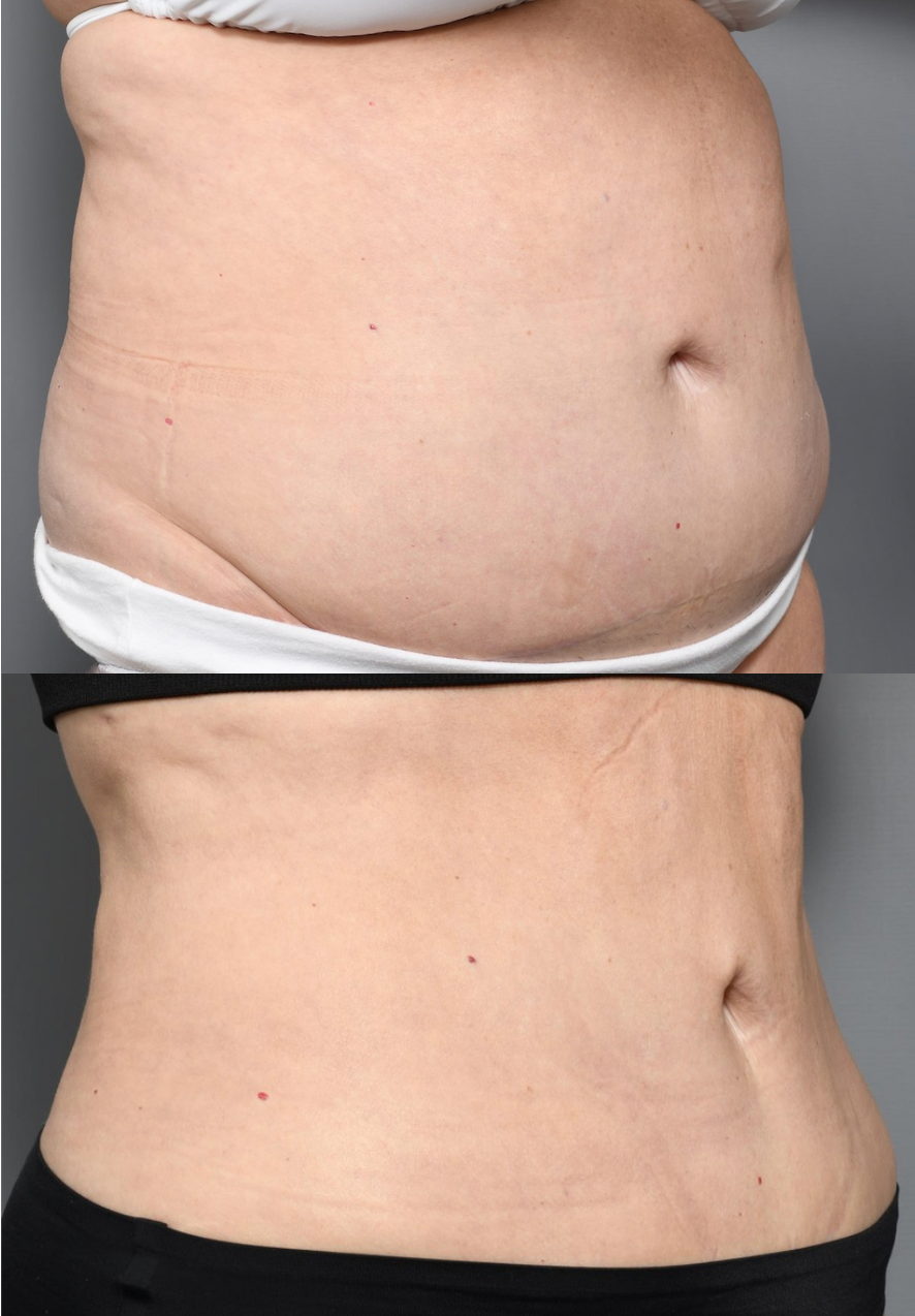 before and after liposuction 
