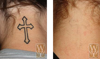 Before-and-after of a neck tattoo removal. A cross tattoo is removed, leaving clean skin.