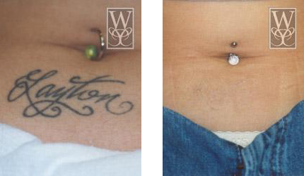 Before-and-after of tattoo removal near navel; black cursive text 