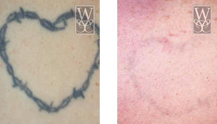 Before and after of a barbed wire heart tattoo removal. Left shows tattoo; right shows fading skin.