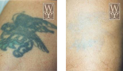 Before and after photos of tattoo removal; original black and green tattoo fades after treatment.