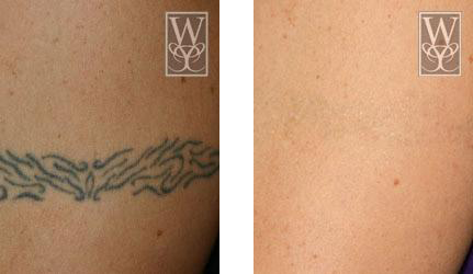 Before-and-after of a tattoo on skin: a black tribal design is removed, leaving smooth skin.