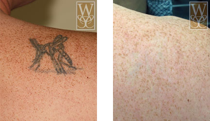 Before and after photos of tattoo removal on shoulder. Tattoo of insect before removal, clear skin after.