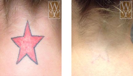 Before and after of tattoo removal. Left: Red star tattoo on neck. Right: Faded tattoo after removal.