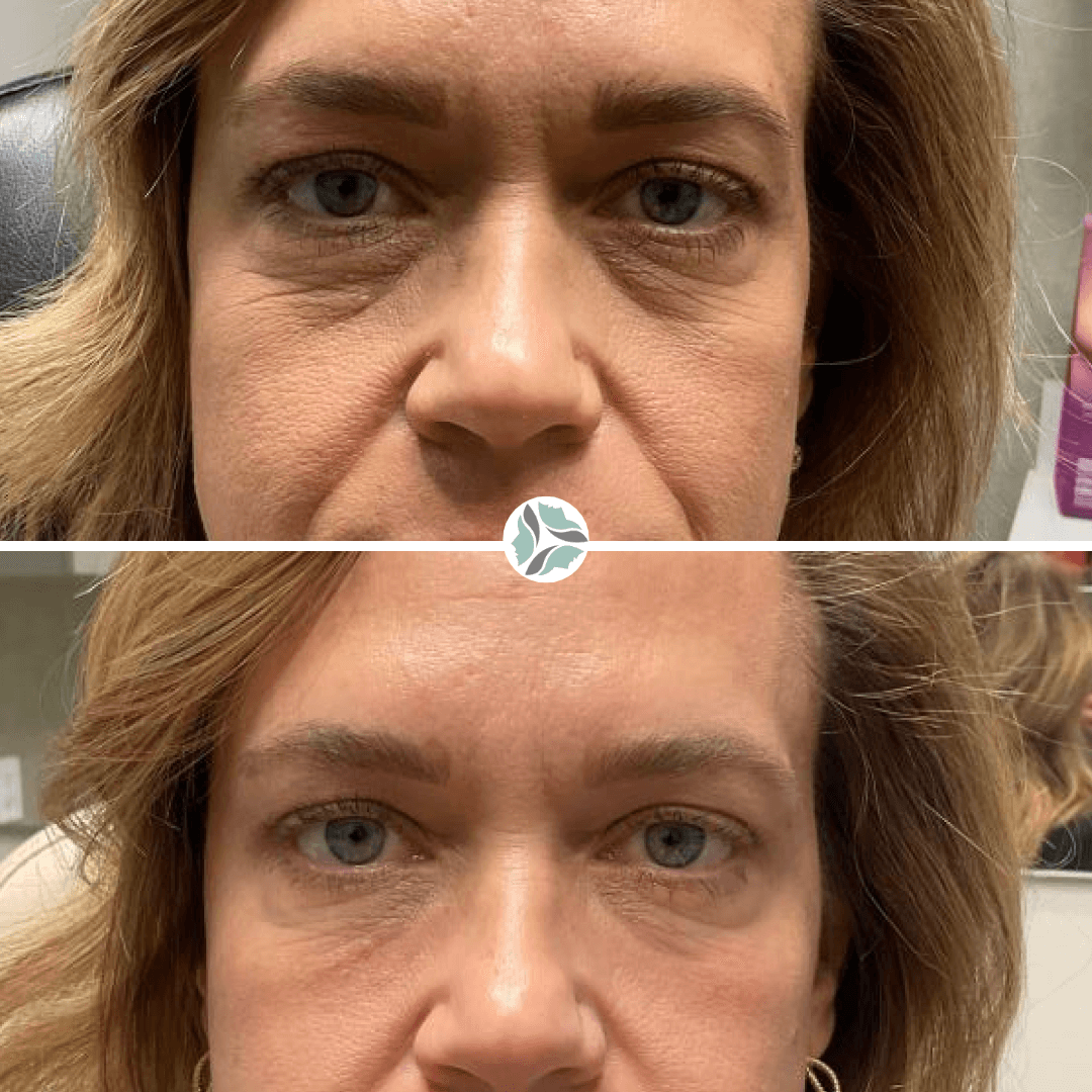 Before and after comparison of a person's eyes, showing a reduction in wrinkles and improved appearance.