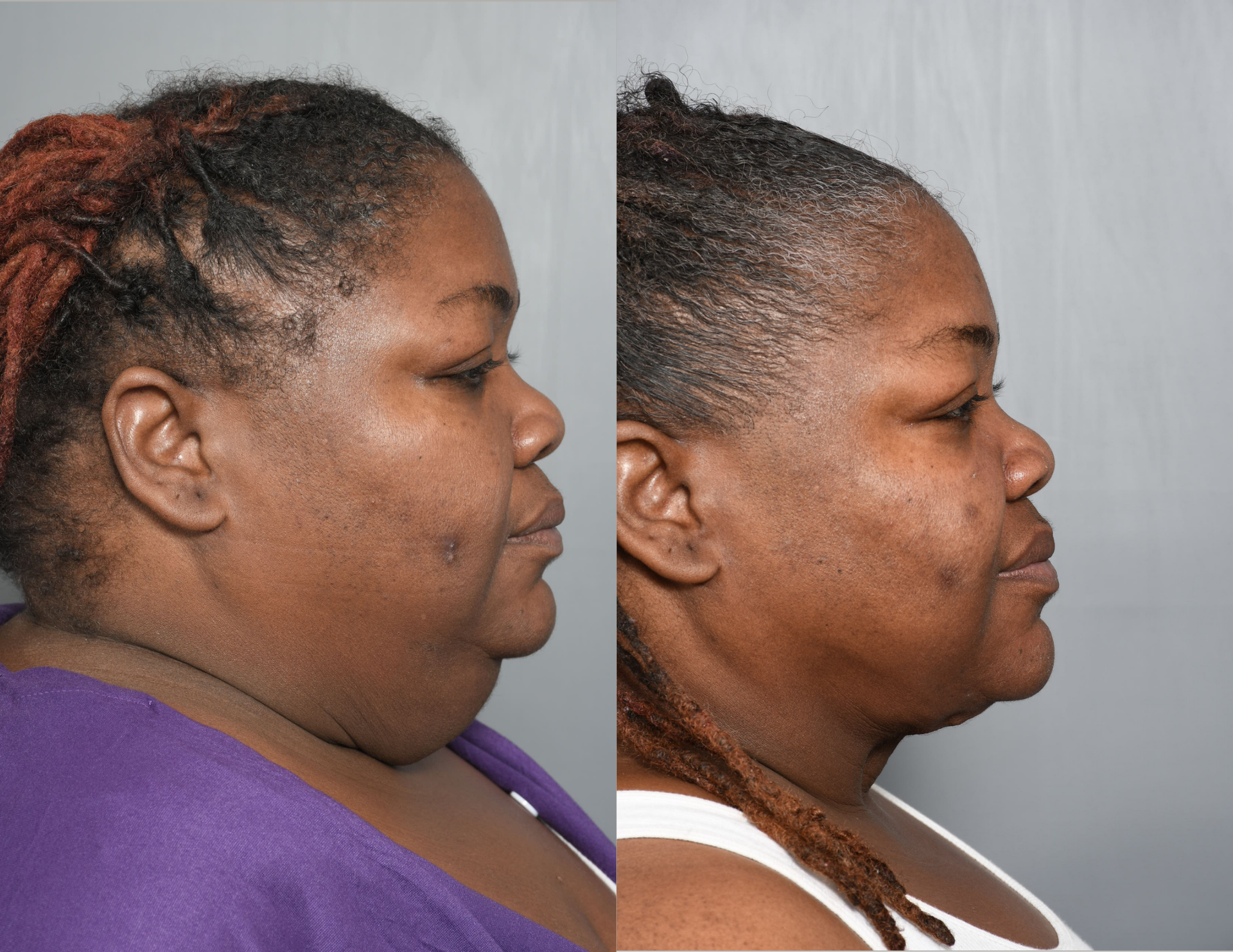 Facelift patient with Williamson Cosmetic Center & Perenack Aesthetic Surgery