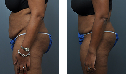 Side-by-side view of a torso. Before (left) and after (right) body contouring, showing abdominal and hip changes.