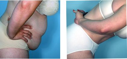 Side-by-side view of a torso. Before and after photos, showing a woman's midsection being manipulated. Blue background.