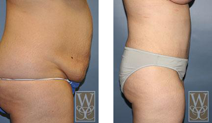 Before and after side view of a torso with visible reduction in abdominal fat after a surgical procedure.