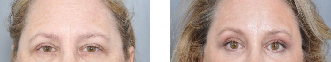 Two close-up photos of a person's eyes, before and after a cosmetic procedure.