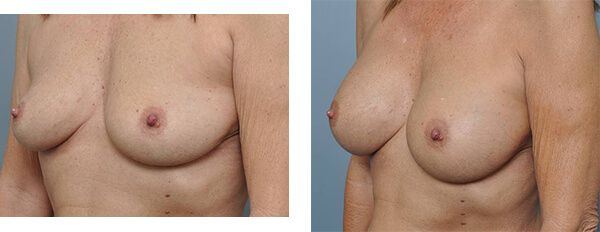 Breasts before and after surgery.