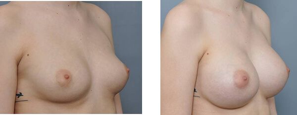 Two side-by-side images of a person's torso. The left image shows smaller breasts, while the right shows larger breasts.