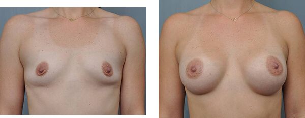 A woman's upper body before and after a breast augmentation.