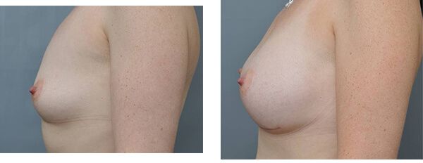 Two side-view photos of a person's torso. Left: small breast. Right: larger breast. Light skin.