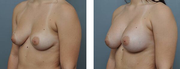 Comparison of breasts before and after surgery.