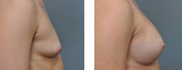Two side-view photos of a person's chest, showing a difference in breast size, likely before and after surgery.