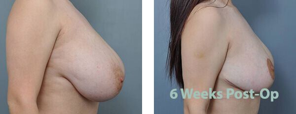 Breast augmentation before and after. Right side shows result 6 weeks post-op.