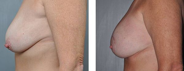 Before and after breasts, showing augmentation. Left breast is smaller, right is larger.