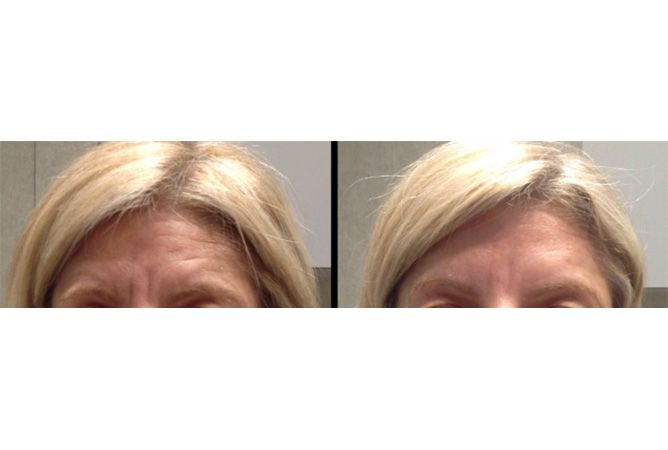 Forehead before and after treatment, wrinkles visibly reduced. Blonde hair, neutral background.