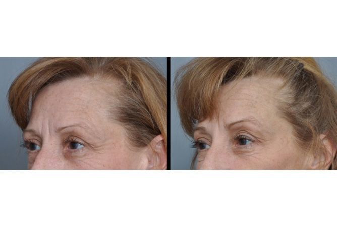 Before and after photos of a woman's hairline, showing hair growth following a cosmetic procedure.
